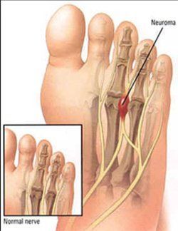 A diagram of a foot with a normal nerve and a neuroma