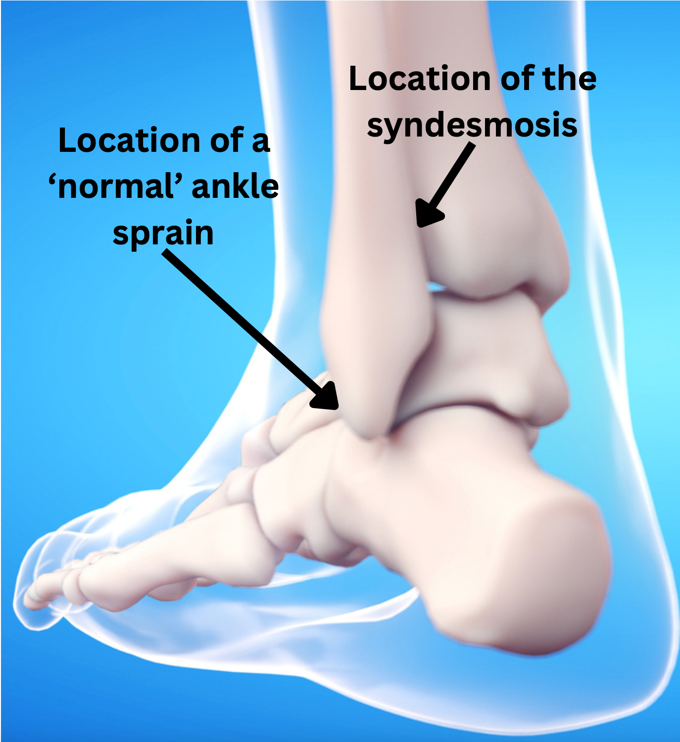 A diagram showing the location of a normal ankle sprain