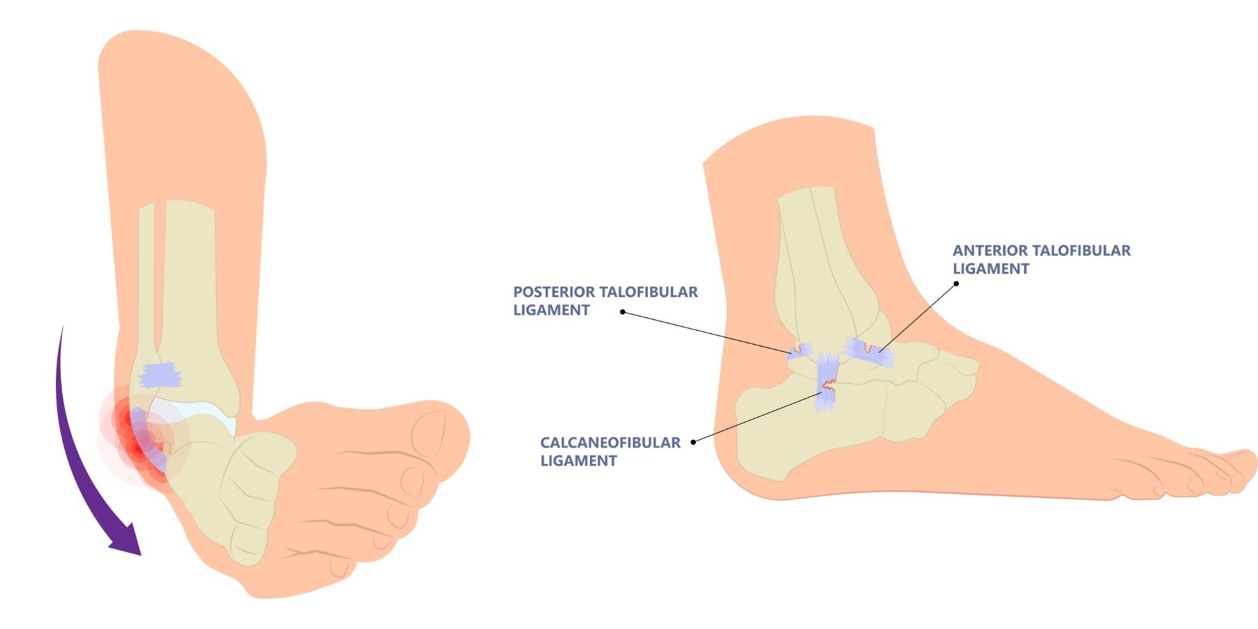 A diagram of a person 's foot with a broken ankle.