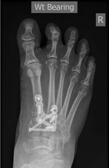 An x-ray of a foot with a wt bearing