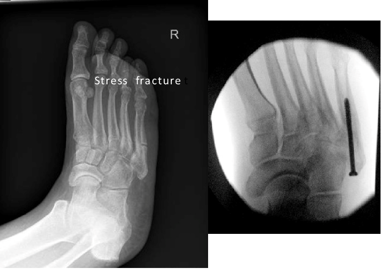 An x-ray of a foot with a stress fracture and an x-ray of a foot with a screw in it.