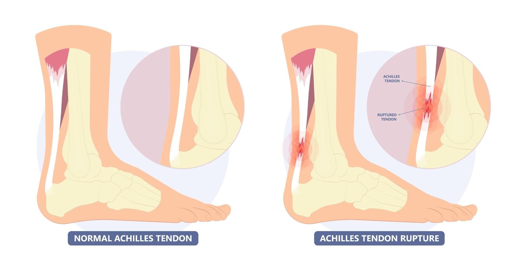 A diagram of a normal achilles tendon and an achilles tendon rupture.