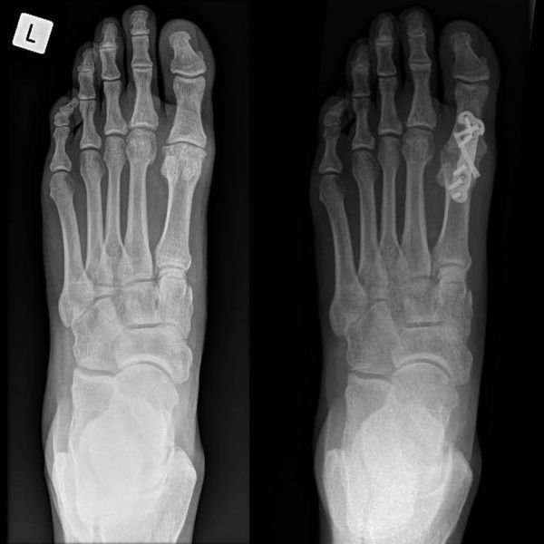 A pair of x-rays of a person 's foot showing the bones of the foot.