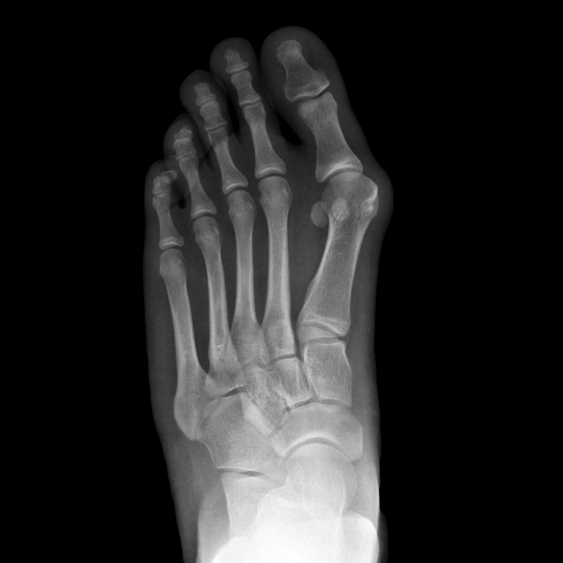An x-ray of a person 's foot showing the bones of the foot.