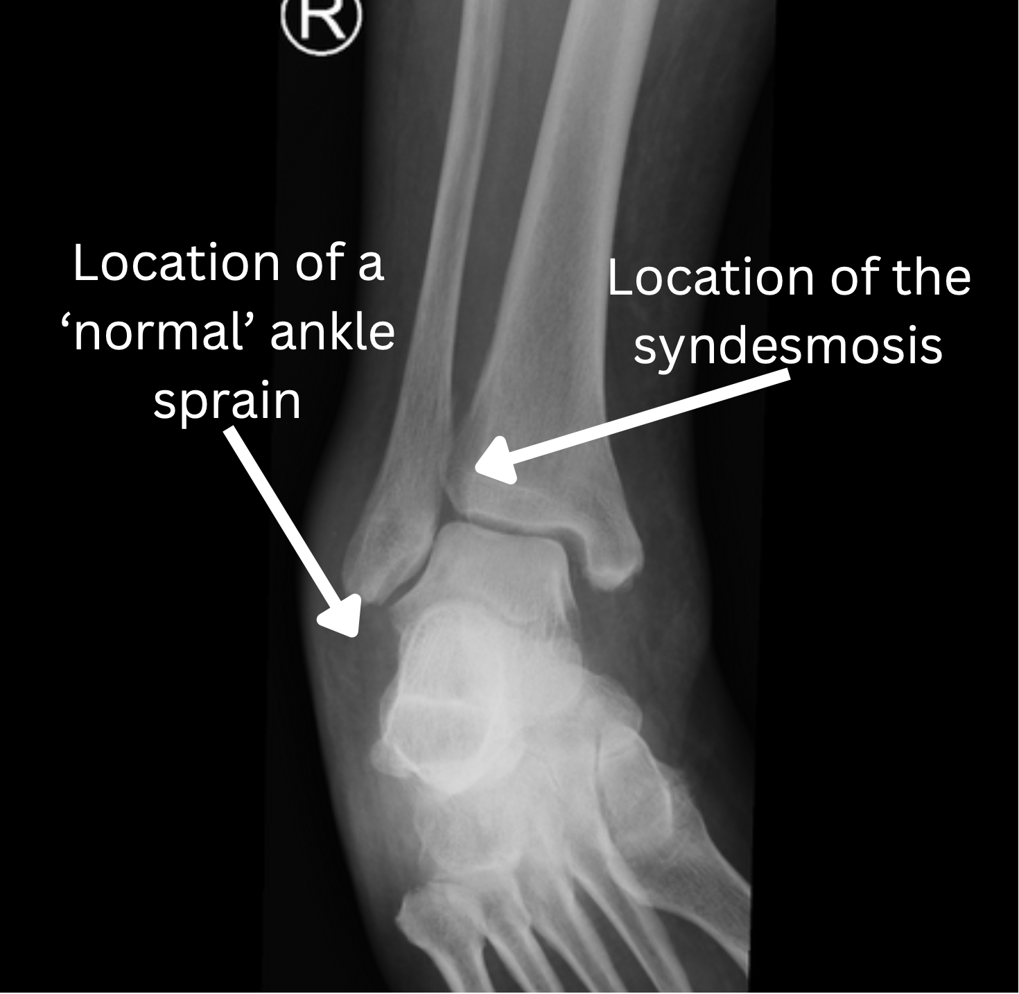 An x-ray shows the location of a normal ankle sprain and the location of the syndesmosis