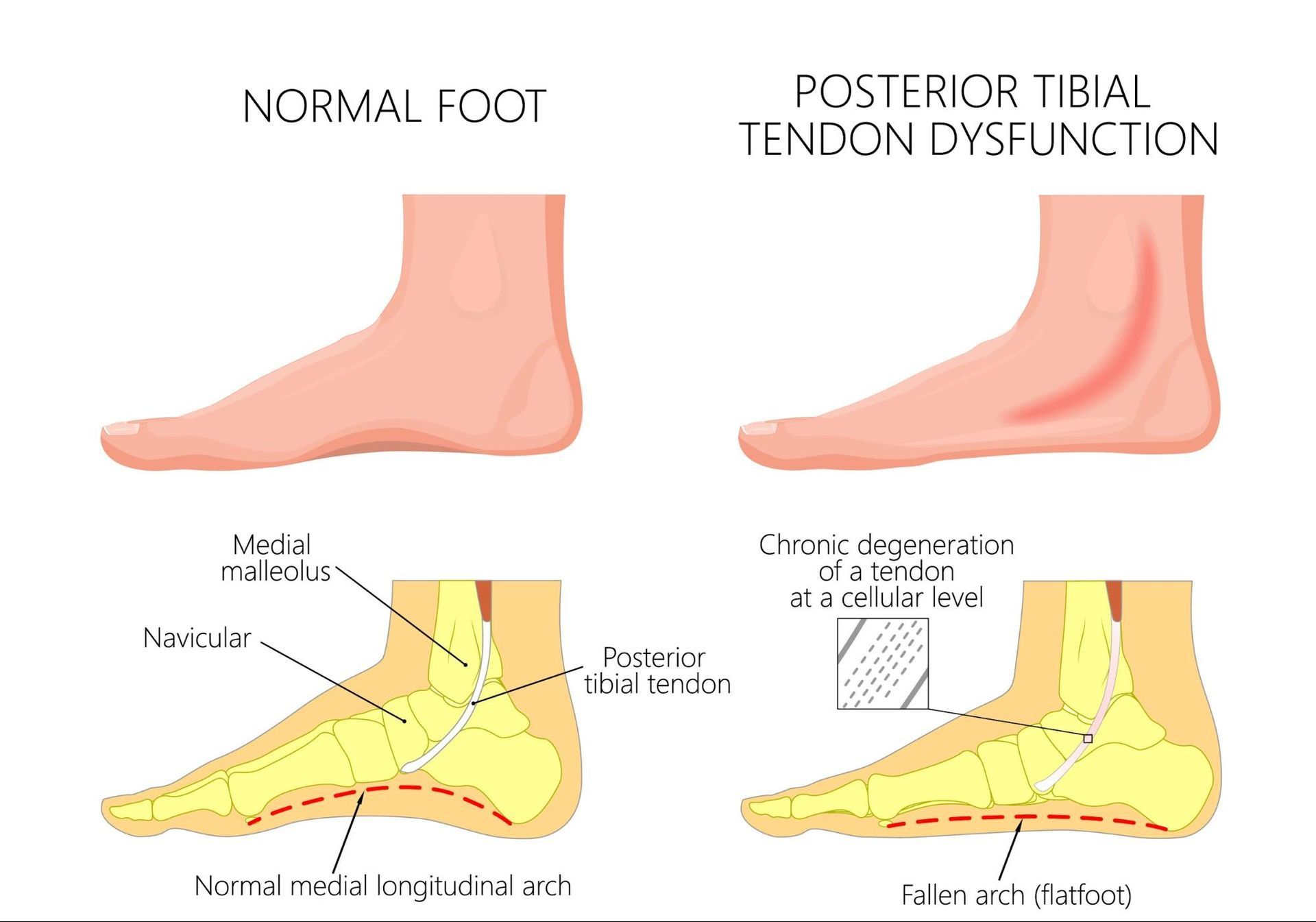 A diagram of a normal foot and a posterior tibial tendon dysfunction