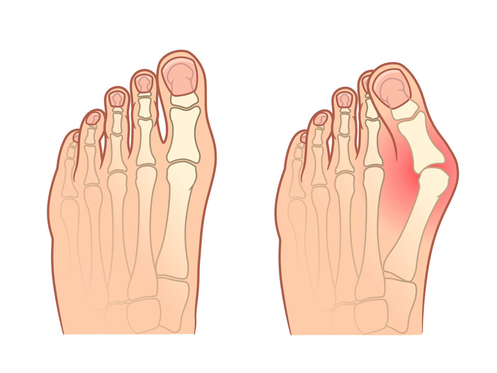 A drawing of a foot with a swollen toe and a normal toe.