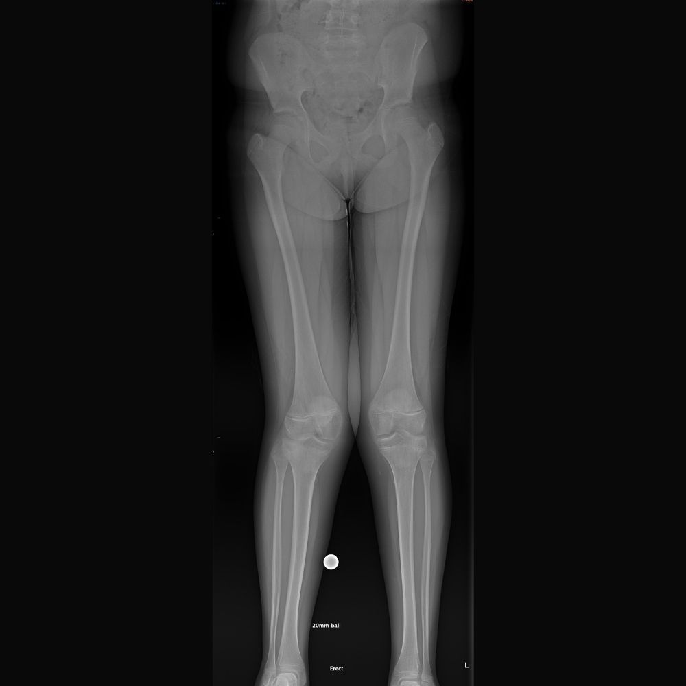 An x-ray of a child 's legs and knee joints.
