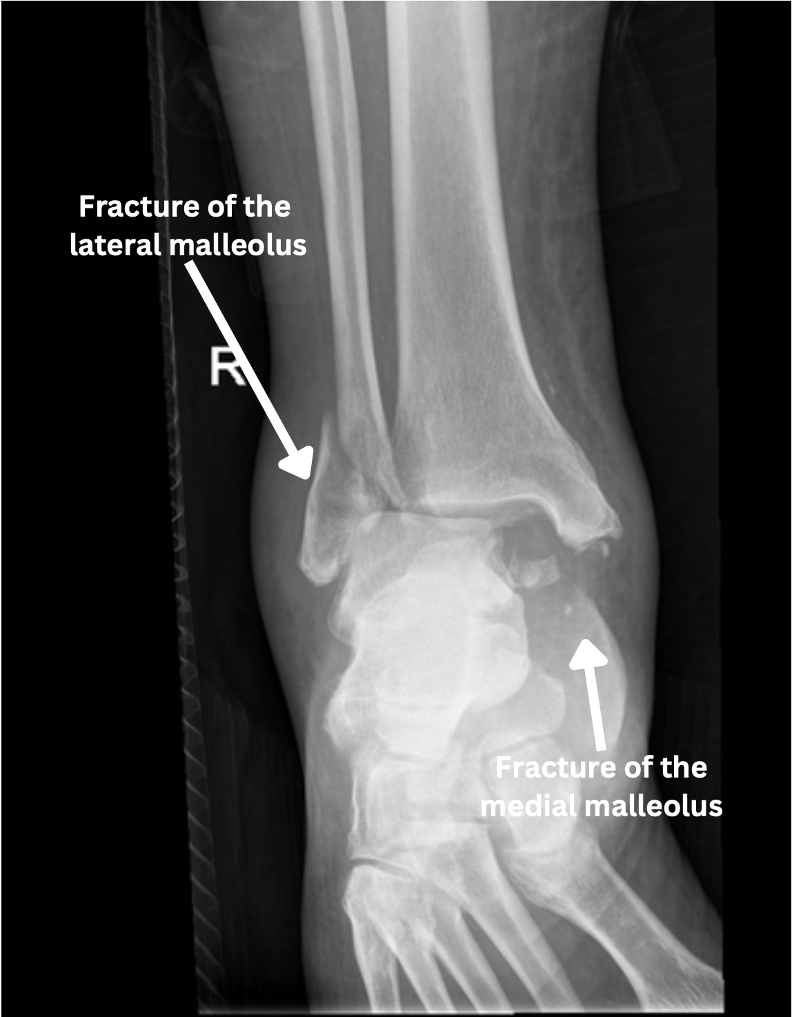 An x-ray of a person 's ankle showing a fracture of the lateral malleolus