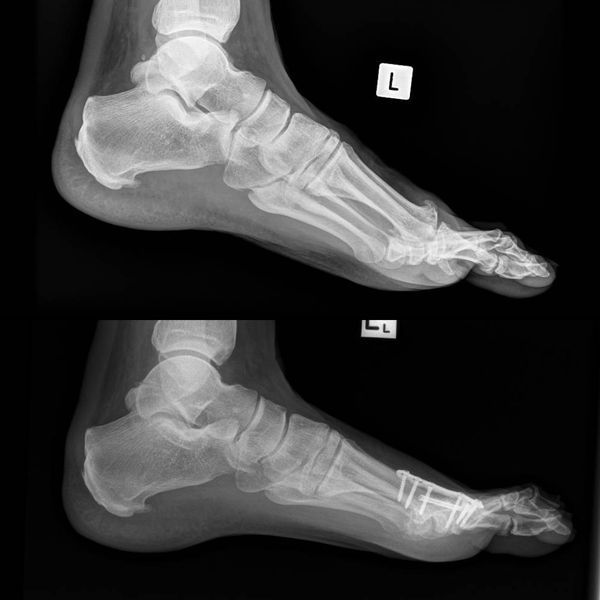 A pair of x-rays of a person 's foot showing the bones of the foot.