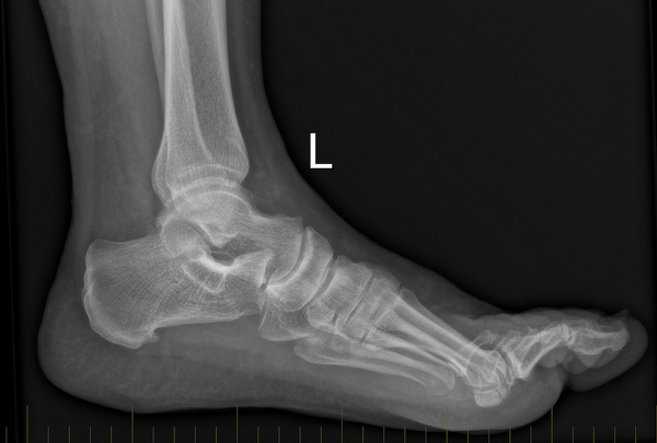An x-ray of a person 's foot with the letter l on it.