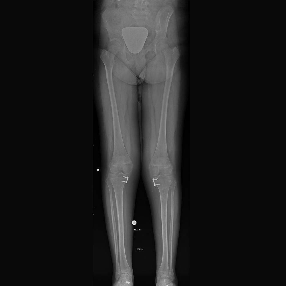 An x-ray of a child 's legs and knee joints.