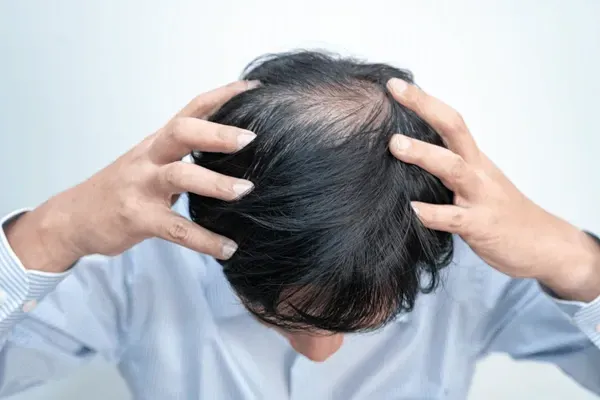 Person Holding Head With Fingers — A9 Skin and Hair Clinic In Westmead, NSW
