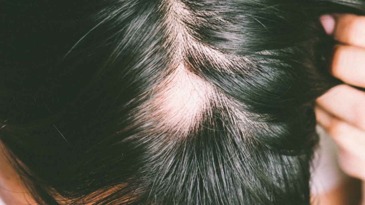 Close-up of a Scalp With a Visible Thinning Patch — A9 Skin and Hair Clinic In Westmead, NSW