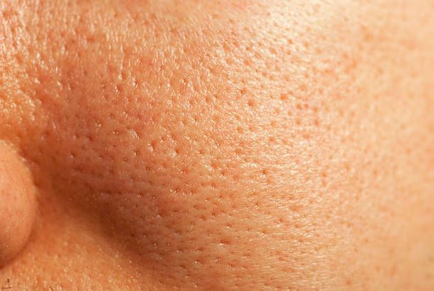 Close-up of Skin With Visible Pores — A9 Skin and Hair Clinic In Westmead, NSW