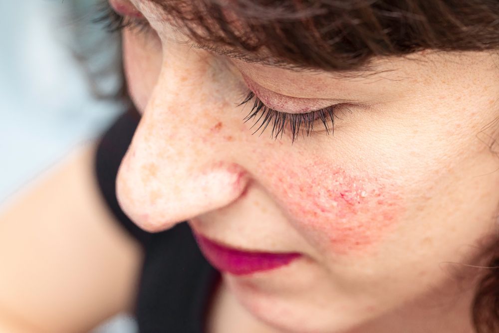 Close-up of a Person’s Face With Red — A9 Skin and Hair Clinic In Westmead, NSW