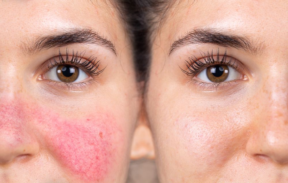 Close-up of a Cheek Before-and-after Treatment — A9 Skin and Hair Clinic In Westmead, NSW