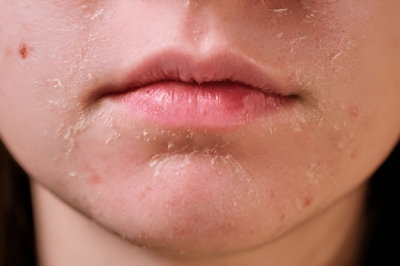 Close-up of a Mouth and Chin With Dry — A9 Skin and Hair Clinic In Westmead, NSW