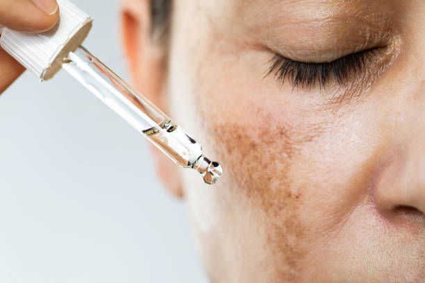 Dropper Applying Serum to a Cheek — A9 Skin and Hair Clinic In Westmead, NSW