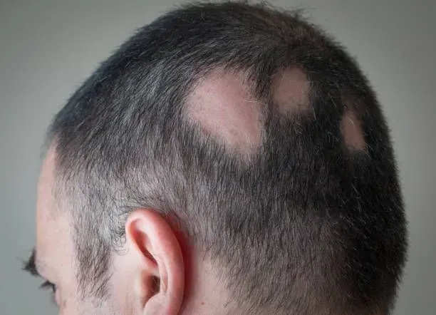 Close-up of the Back of a Person’s Head — A9 Skin and Hair Clinic In Westmead, NSW