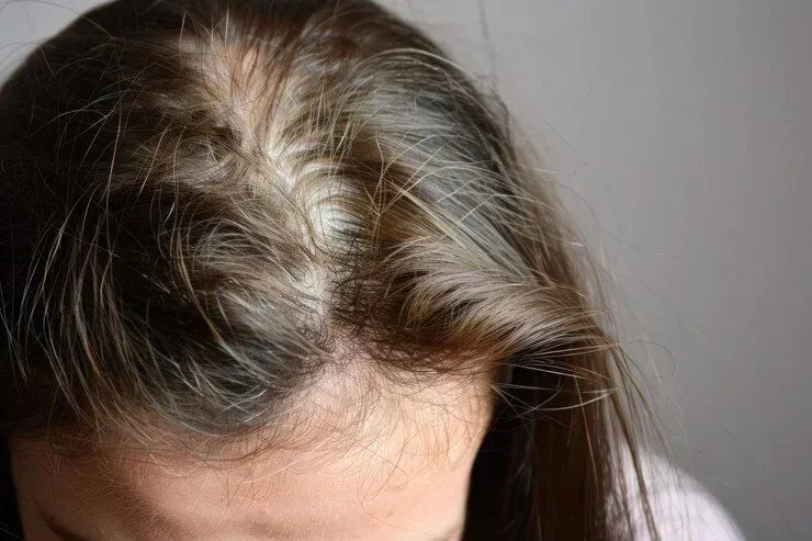 Close-up of Thinning Hair on the Top of a Person's Head — A9 Skin and Hair Clinic In Westmead, NSW