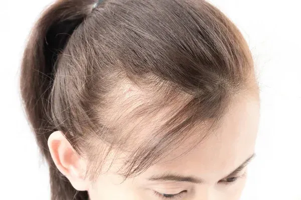 Close-up of a Person With a High Ponytail — A9 Skin and Hair Clinic In Westmead, NSW
