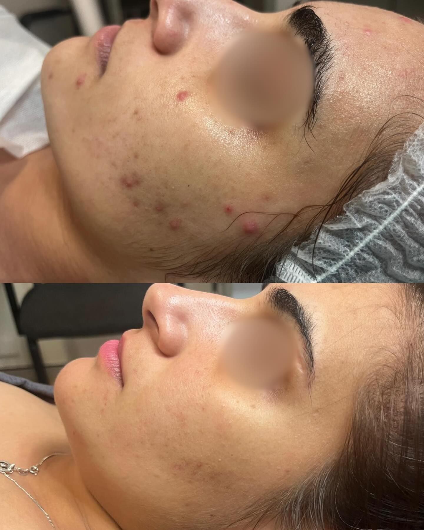 Side-by-side Close-up of a Face — A9 Skin and Hair Clinic In Westmead, NSW