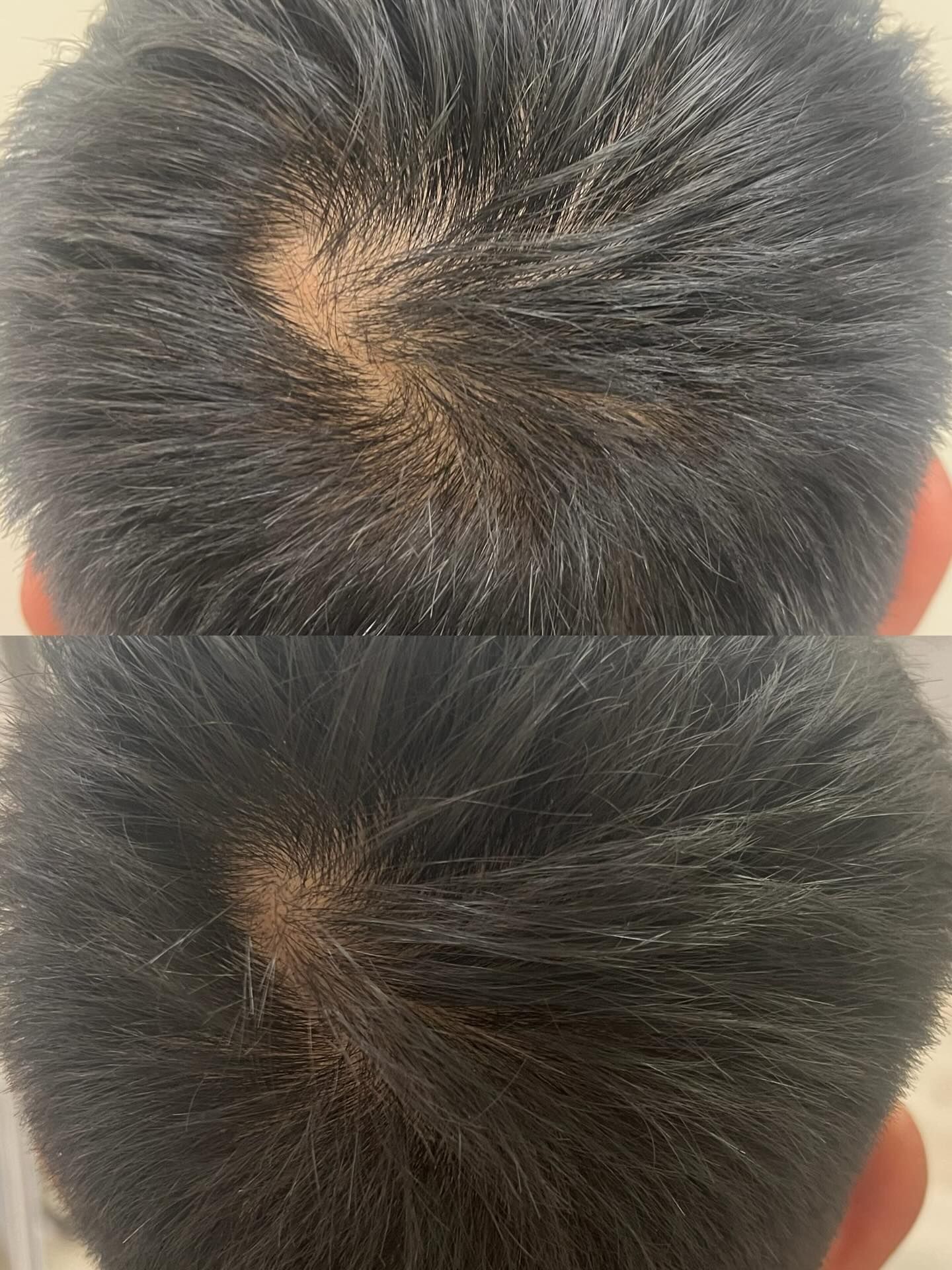 Close-up of Two Crown Swirls in Dark Hair — A9 Skin and Hair Clinic In Westmead, NSW