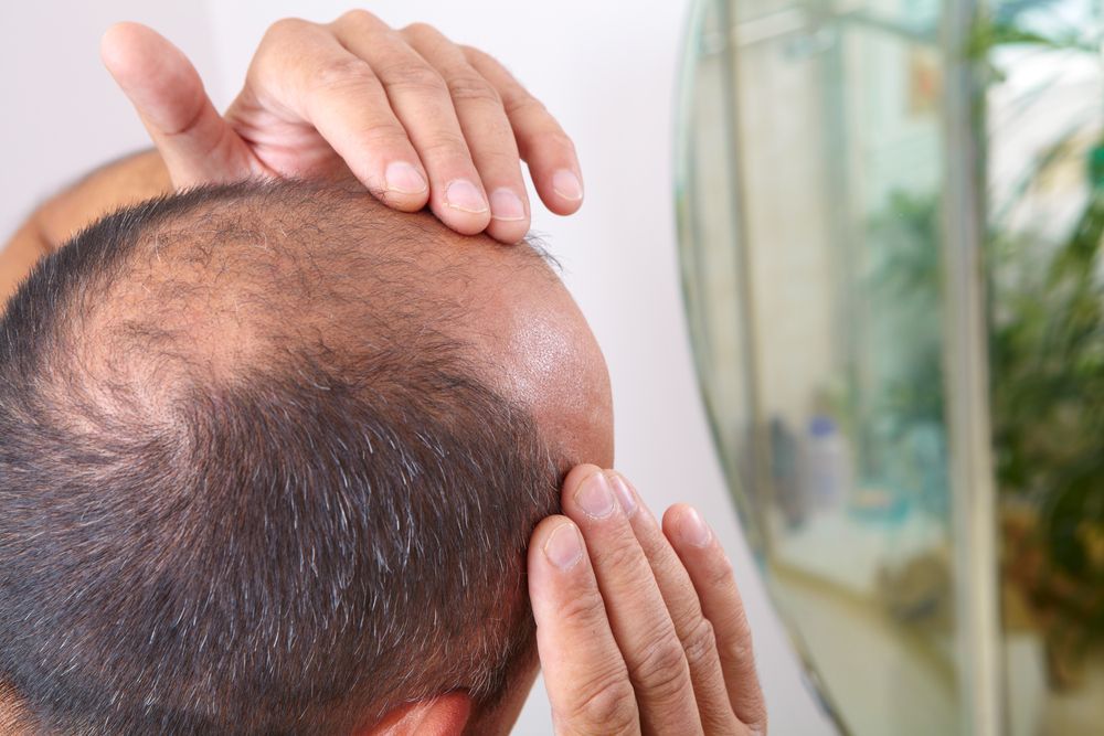 Person Examining a Thinning Scalp in a Bathroom Mirror — A9 Skin and Hair Clinic In Westmead, NSW