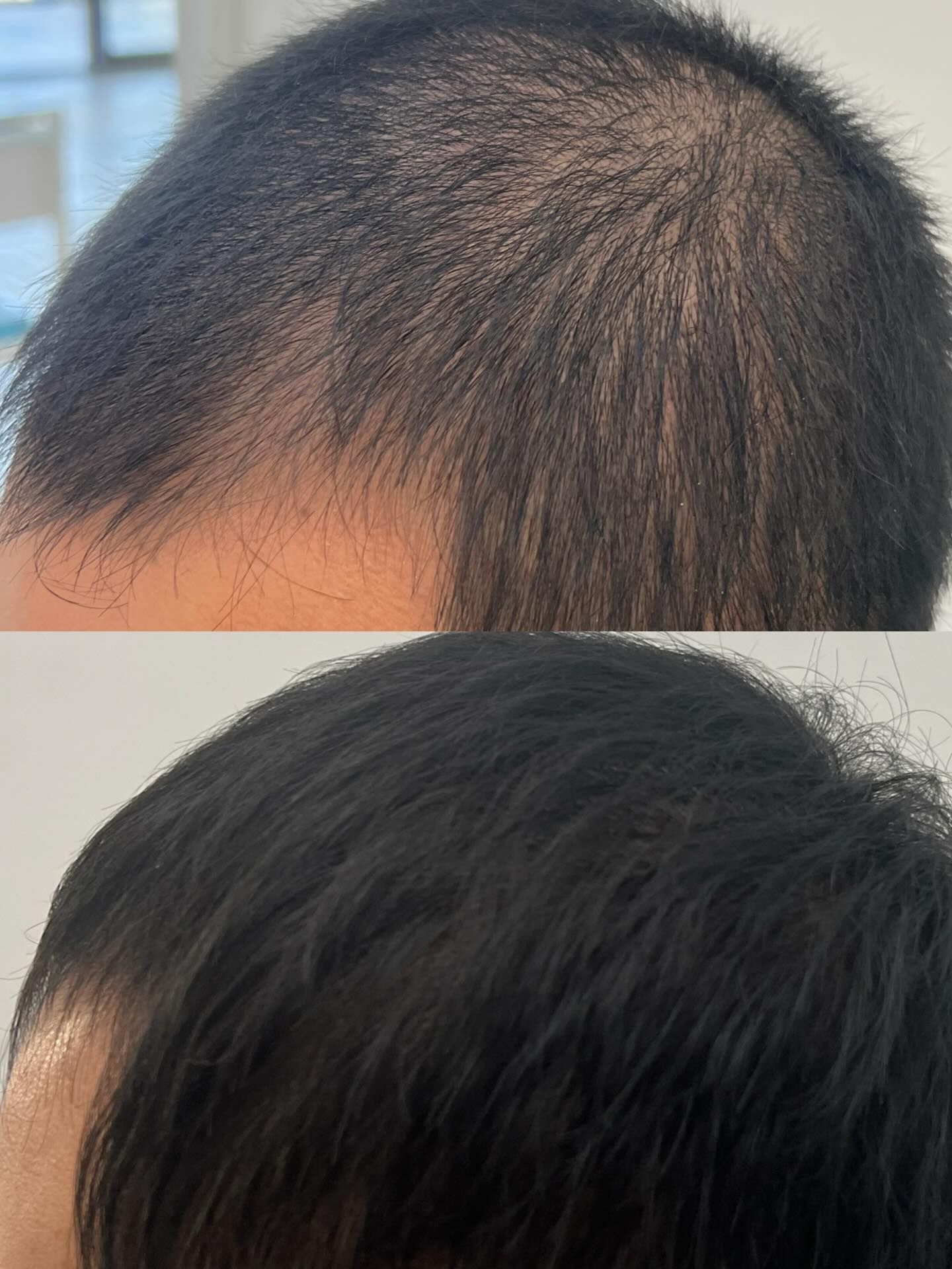 Close-up of a Scalp With Thinning Hair — A9 Skin and Hair Clinic In Western Sydney, NSW