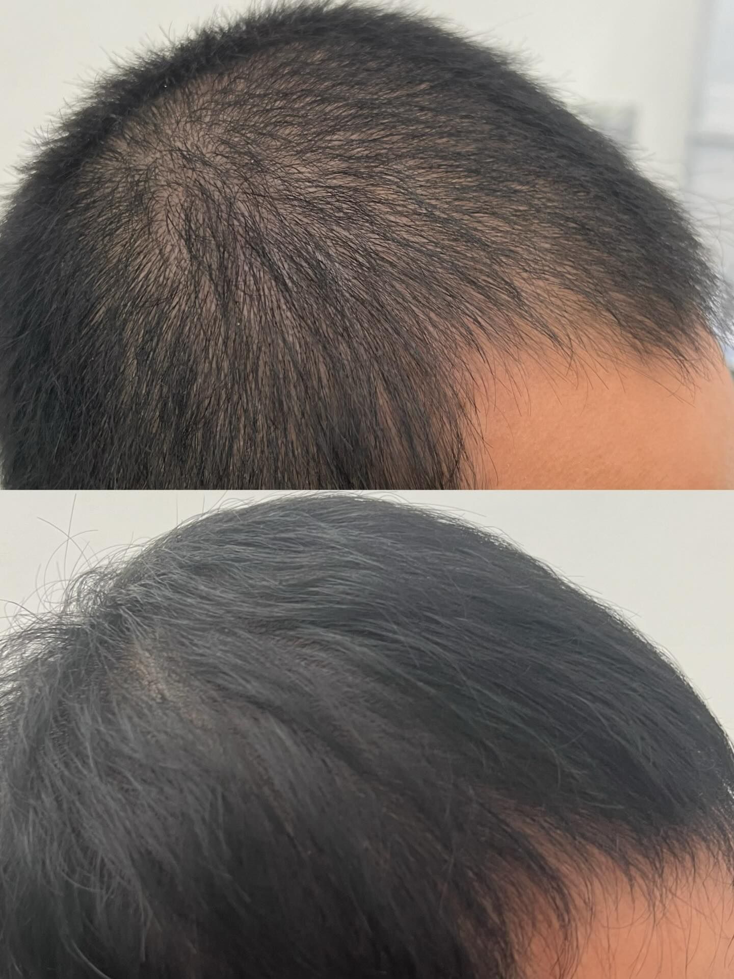 Top and Side Views of a Close-cropped Dark Hairstyle — A9 Skin and Hair Clinic In Westmead, NSW