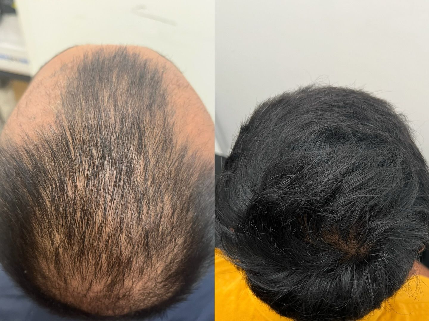Two Overhead Photos of a Thinning Scalp — A9 Skin and Hair Clinic In Westmead, NSW
