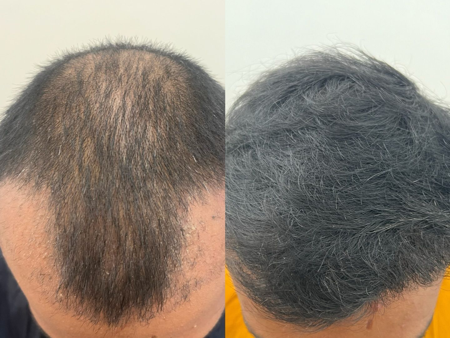 Top-down Comparison of Thinning and Fuller Dark Hair on a Scalp — A9 Skin and Hair Clinic In Sydney, NSW