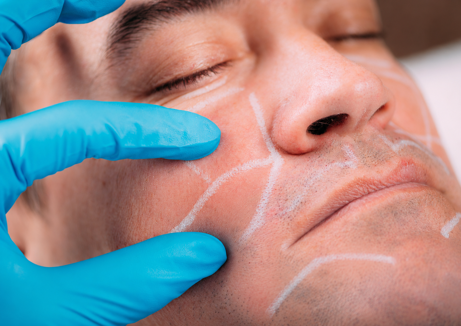 Aesthetic Treatment Being Applied to a Reclining Patient’s Face — A9 Skin and Hair Clinic In Westmead, NSW