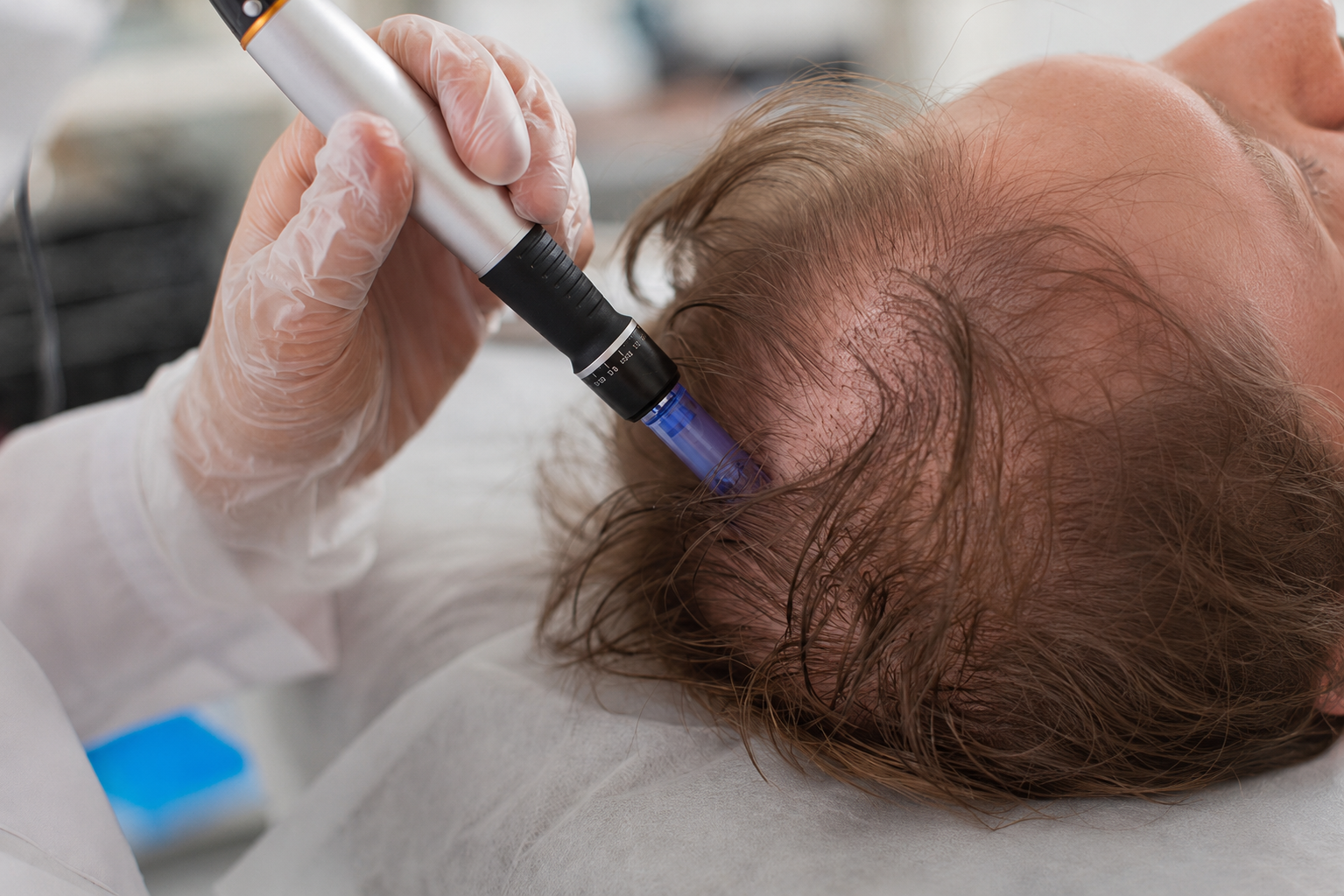 Back of a Bald Man’s Head While a Hand Holds — A9 Skin and Hair Clinic In Westmead, NSW