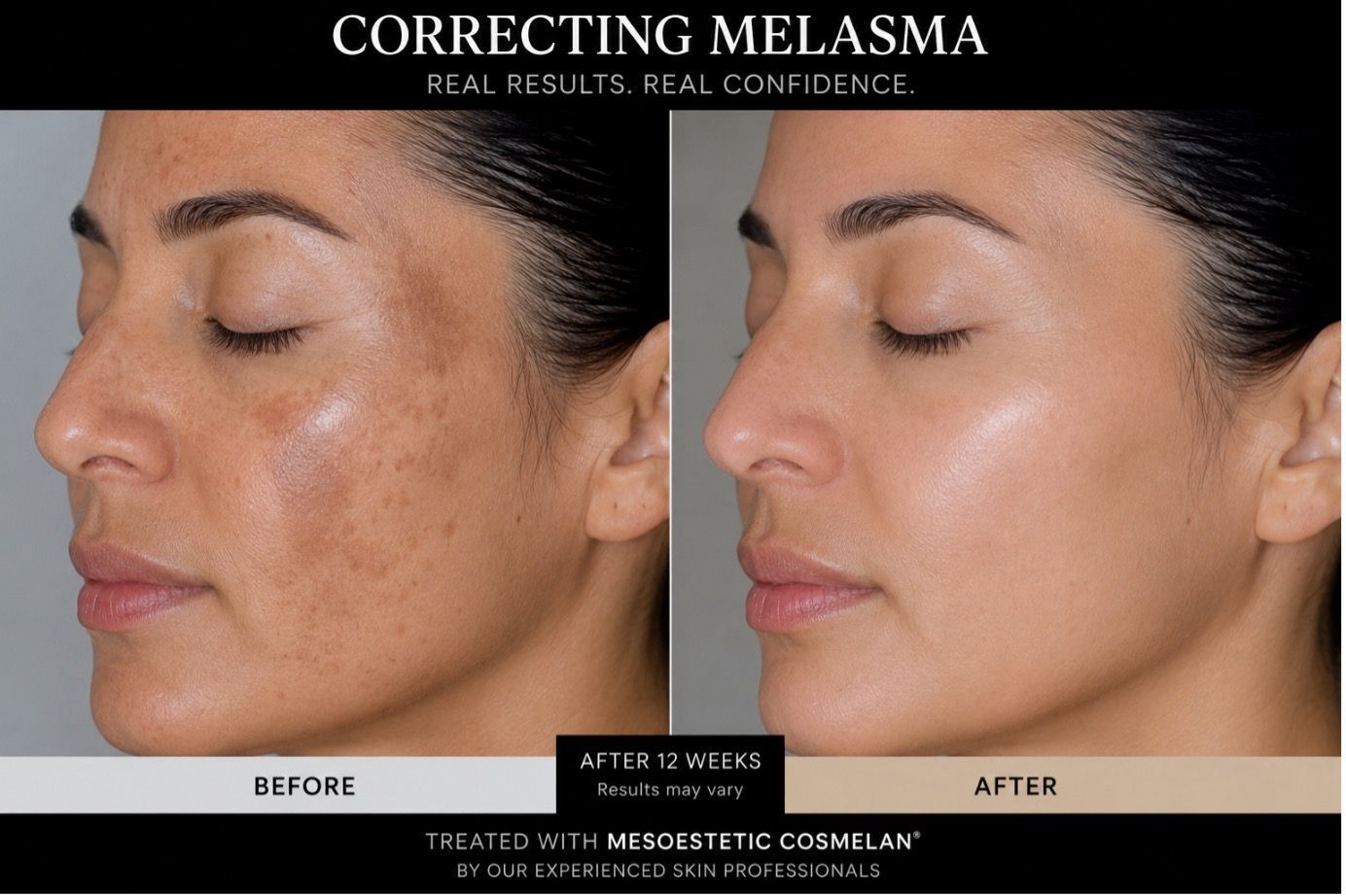 Before-and-after Side-by-side of a Woman’s Cheek— A9 Skin and Hair Clinic In Westmead, NSW