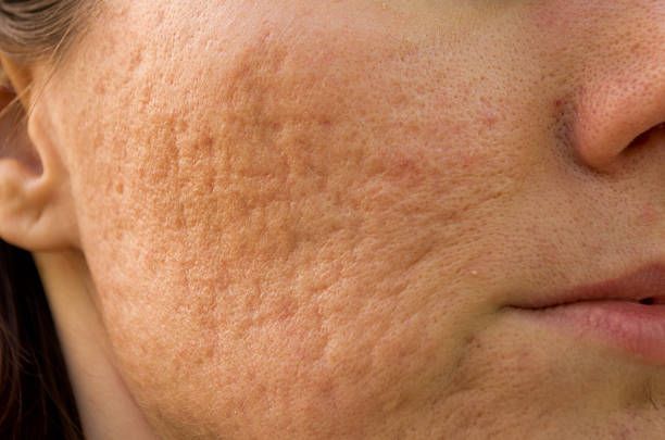 Close-up of a Cheek With Visible Acne Scars — A9 Skin and Hair Clinic In Westmead, NSW