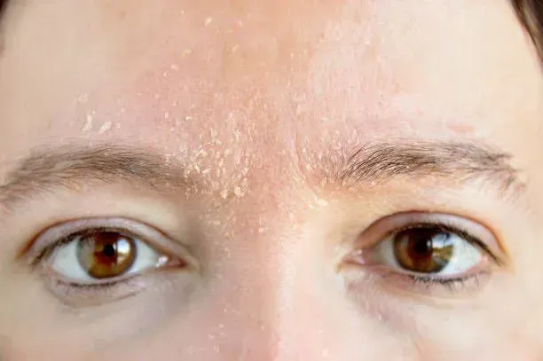 Close-up of a Person’s Eyes and Nose — A9 Skin and Hair Clinic In Westmead, NSW