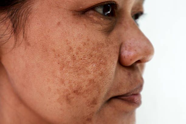 Side Profile of a Face With Visible Brown Facial Spots and Blemishes — A9 Skin and Hair Clinic In Westmead, NSW