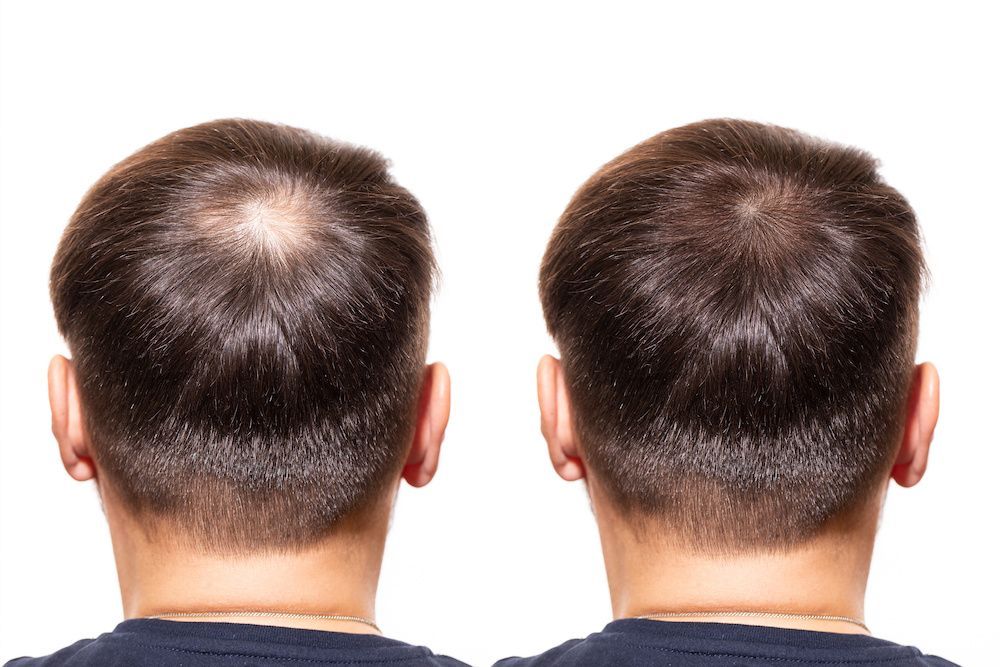 Two Back Views of Short Brown Hair — A9 Skin and Hair Clinic In Westmead, NSW