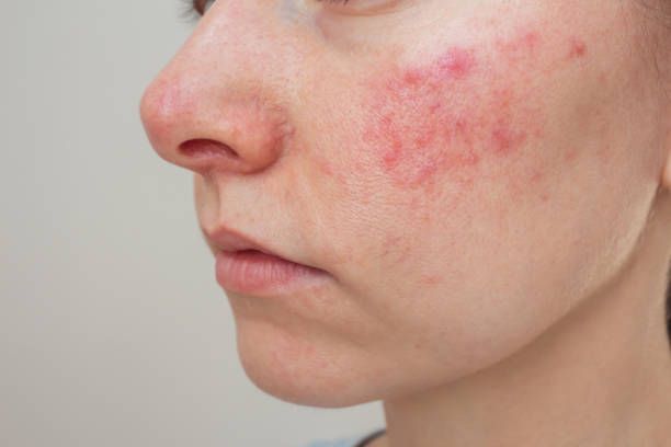Close-up of a Cheek With a Red, Blotchy Rash — A9 Skin and Hair Clinic In Westmead, NSW