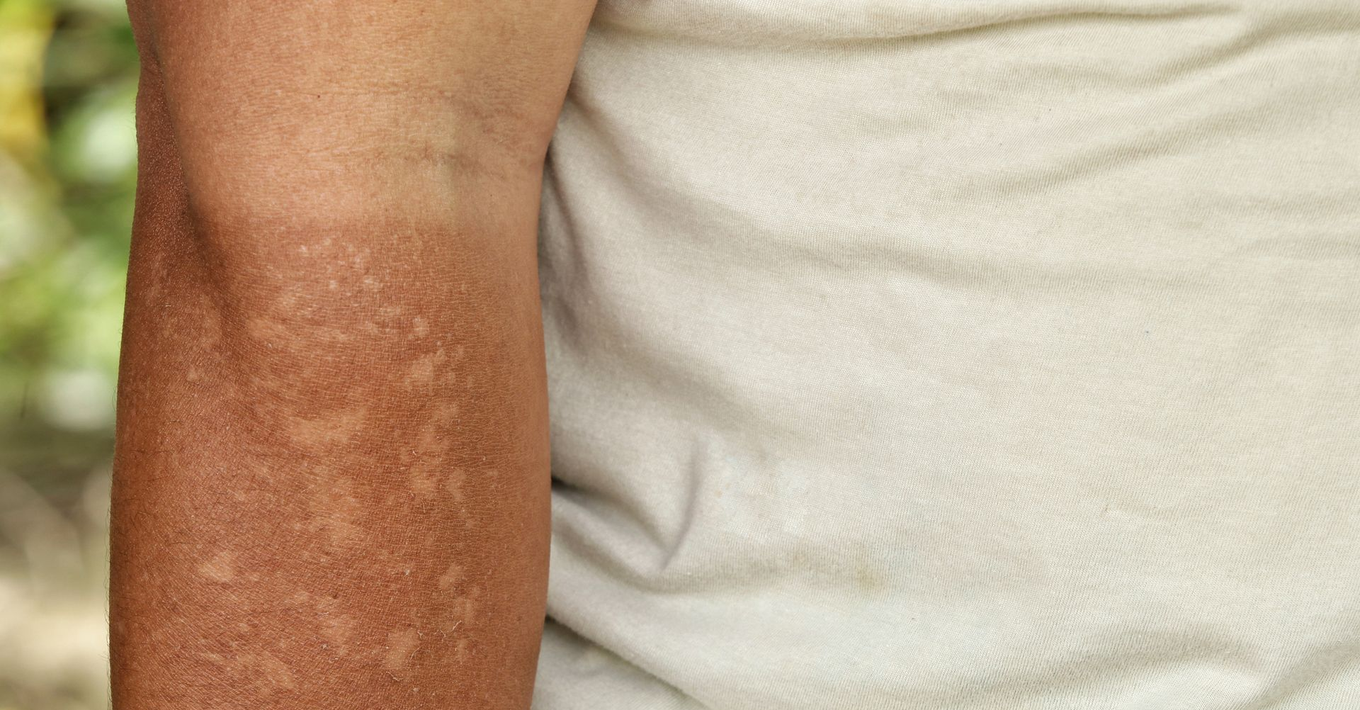 Close-up of a Person's Upper Arm With a Patchy — A9 Skin and Hair Clinic In Westmead, NSW
