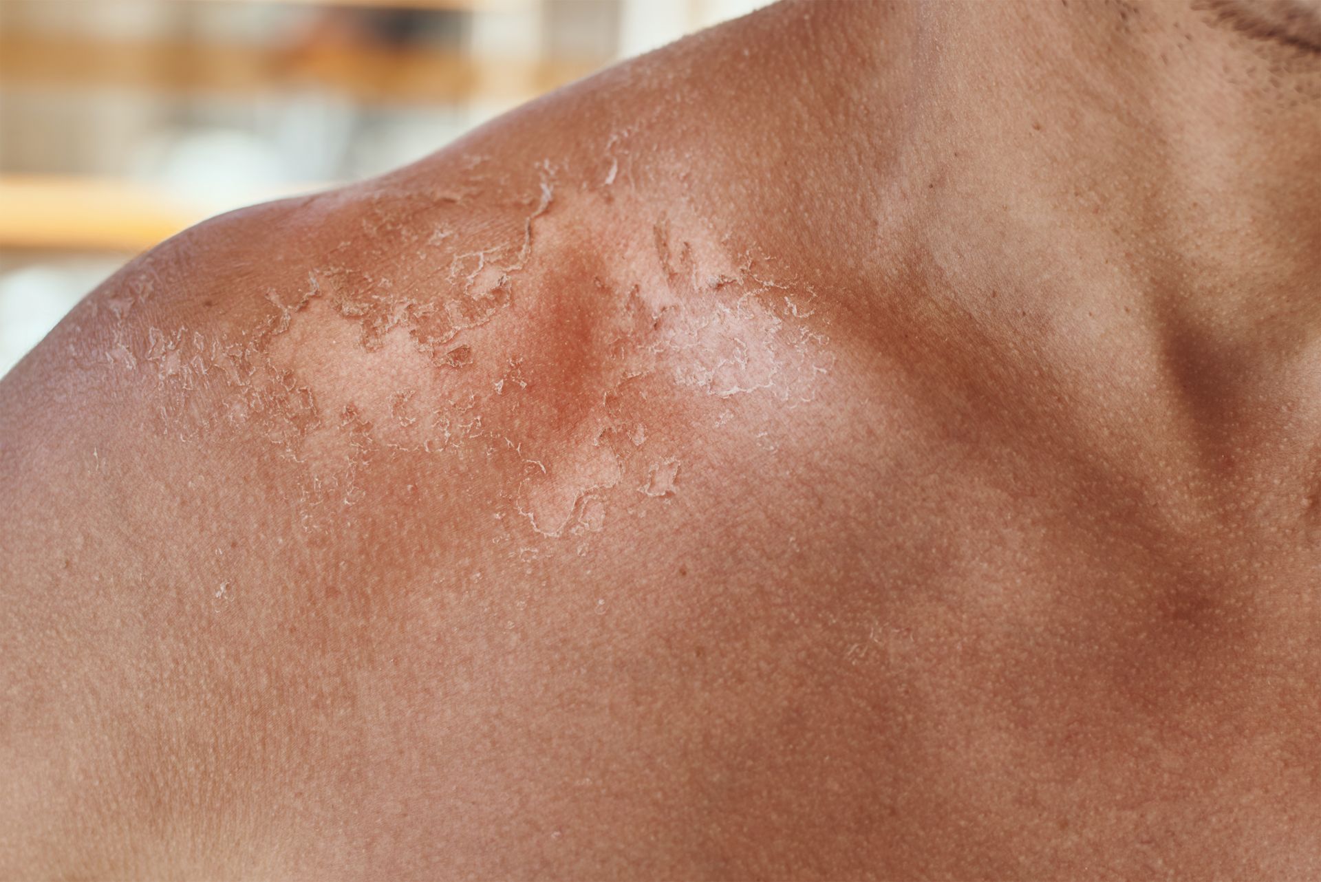 Close-up of a Shoulder With a Raised — A9 Skin and Hair Clinic In Westmead, NSW