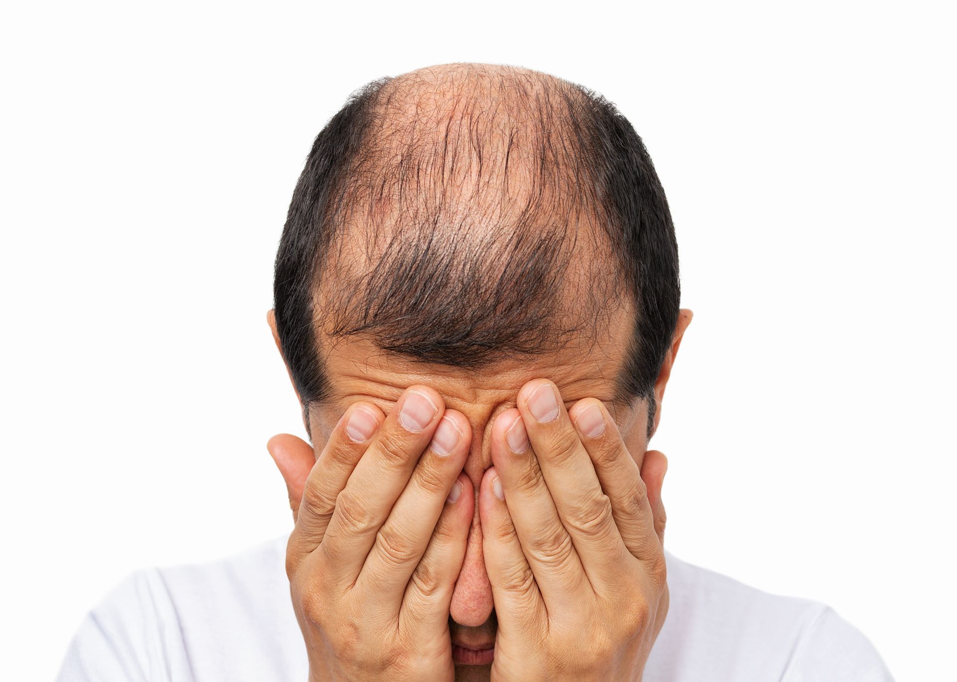 Balding Man Covering His Face With Both Hands — A9 Skin and Hair Clinic In Westmead, NSW