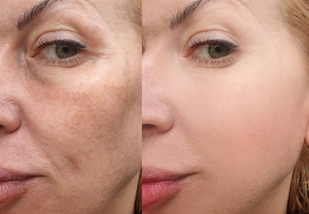 Side-by-side Close-up of a Face Before and After Skin — A9 Skin and Hair Clinic In Westmead, NSW