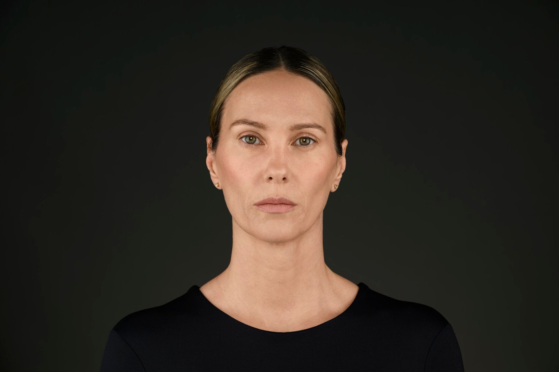 After Evolysse dermal filler treatment at ERA Wellness Spa