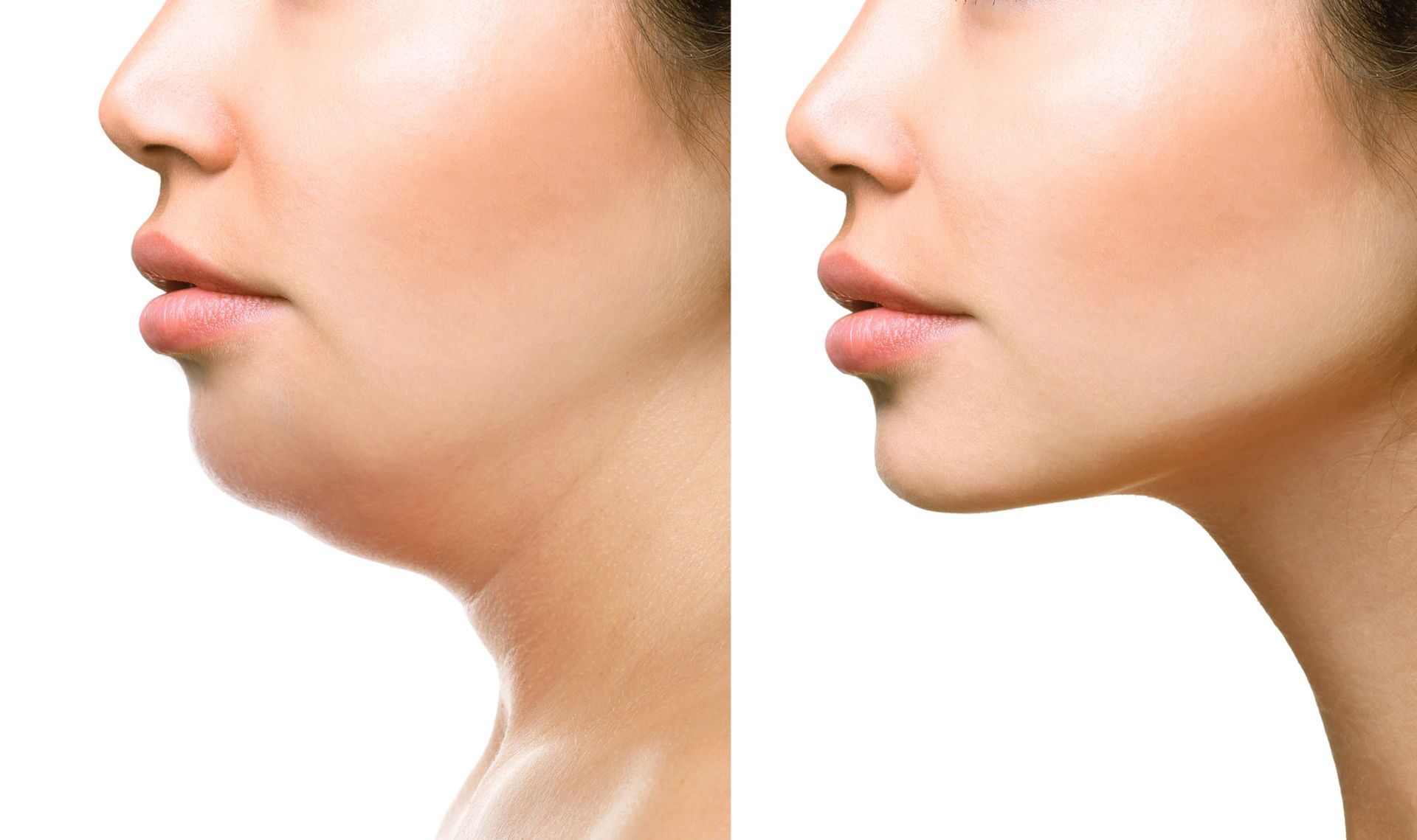 before and after photo of a woman 's face at ERA Wellness Spa