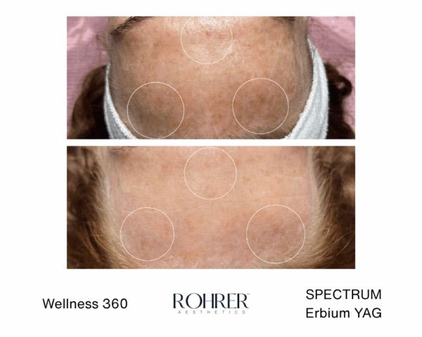 Evergreen Colorado IPL treatment at Lela Skin Care and Facials