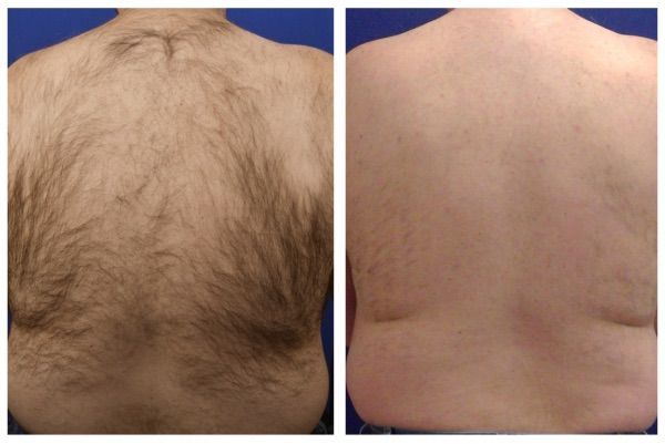 Laser Hair Removal in Evergreen, Colorado at Lela Skin Care and Facials