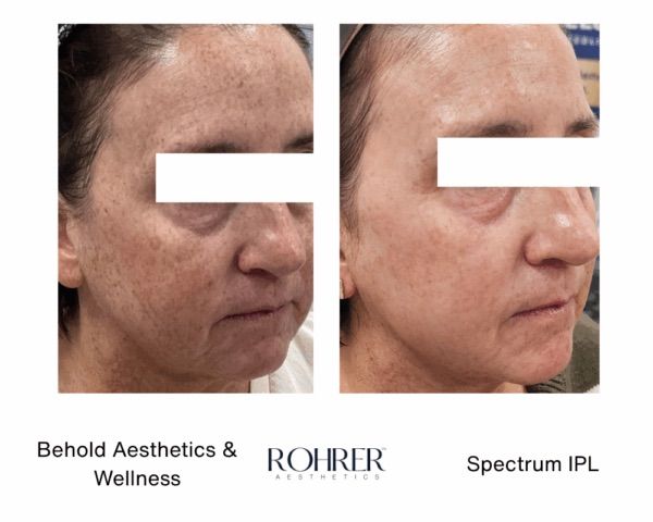 Before and after of intense pulsed light in Evergreen Colorado